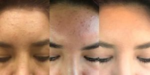 Microneedling Before and After Pictures